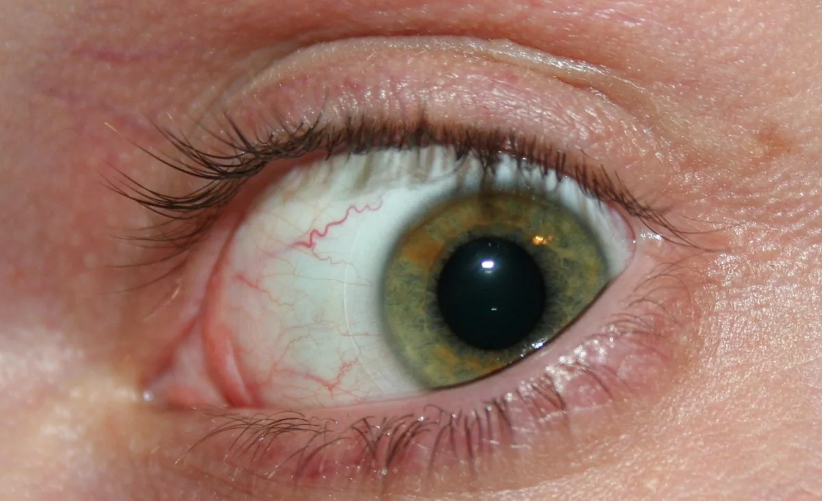 Close-up of a slightly bloodshot eye with the edge of a soft contact lens visible on the white